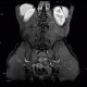 Crohn's disease of ileum, MR enterography: MRI - Magnetic Resonance Imaging